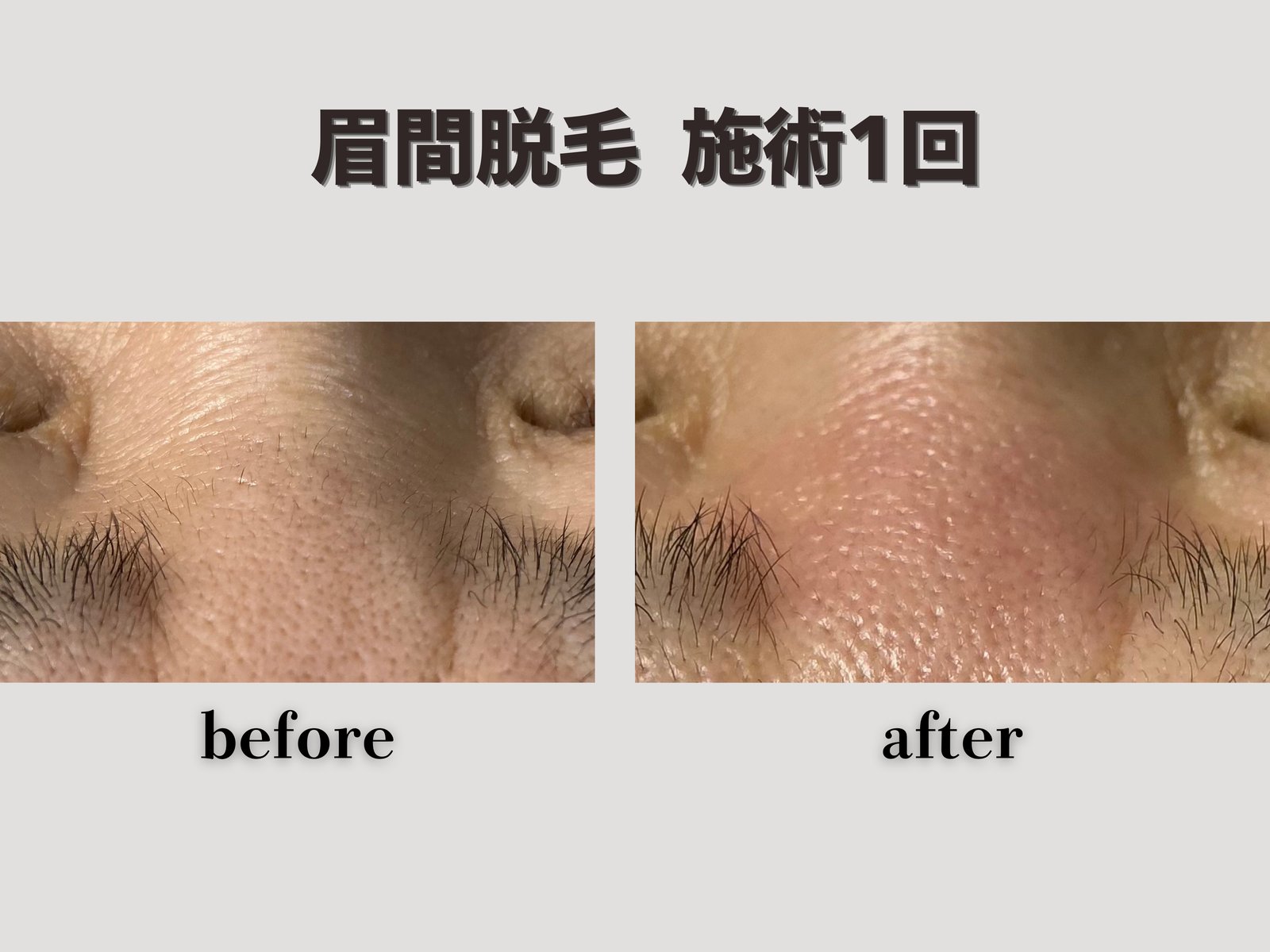 眉間脱毛 施術1回 Before/After