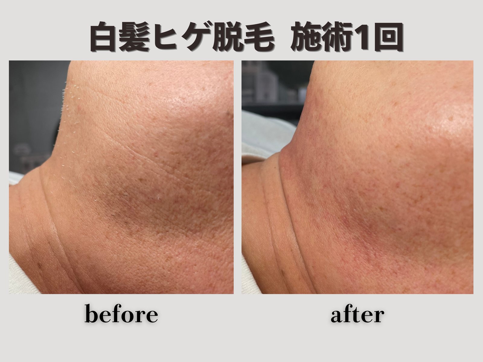 白髪ヒゲ脱毛 施術1回 Before/After