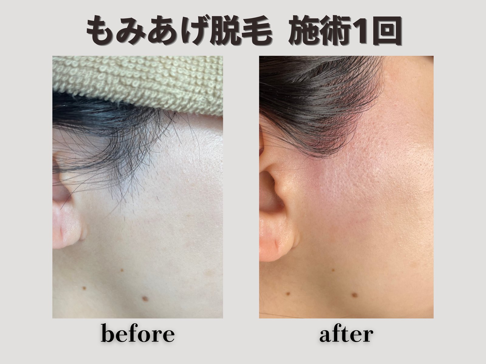もみあげ脱毛 施術1回 Before/After