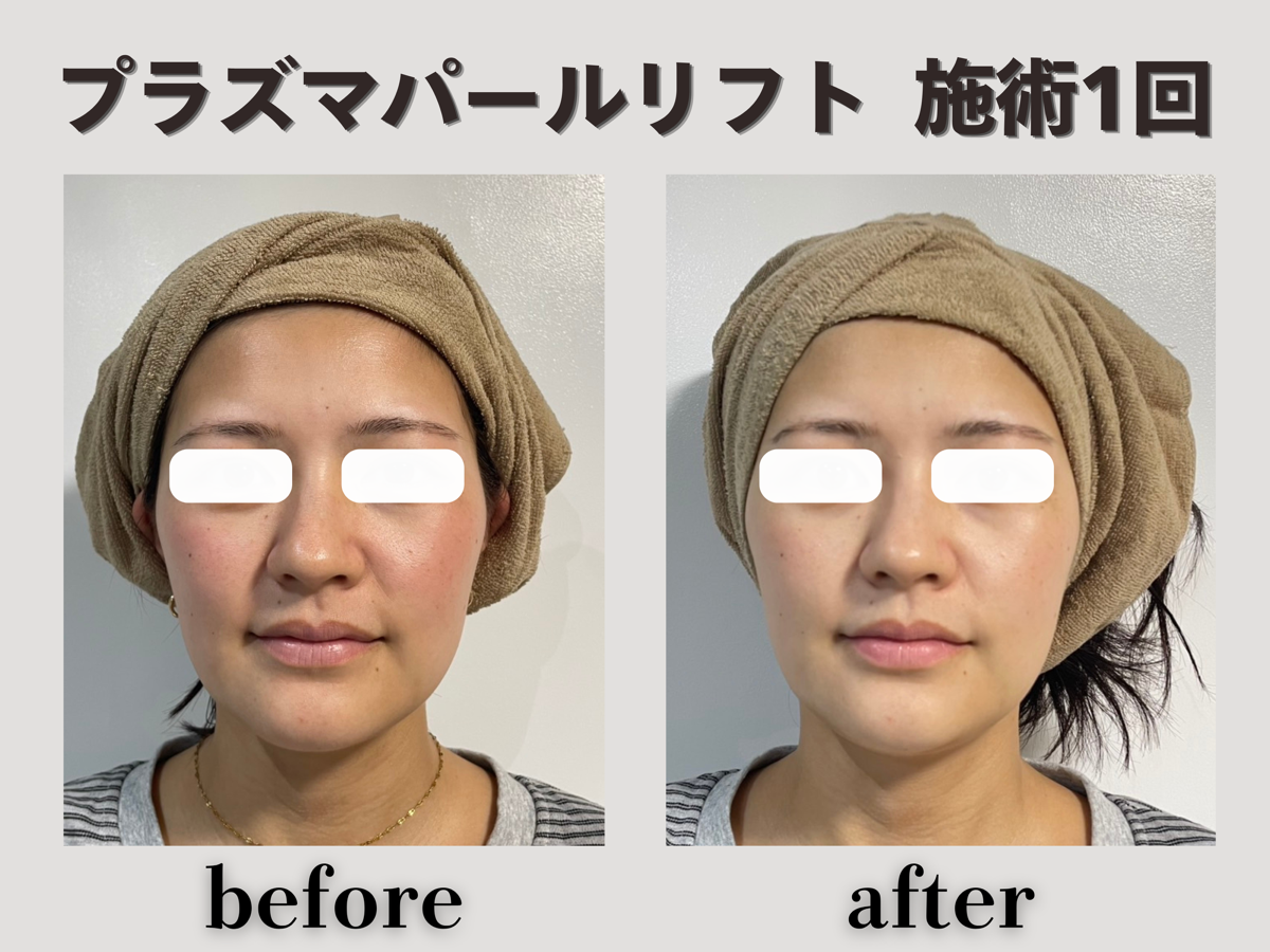 プラズマパールリフト 施術1回 正面 Before/After
