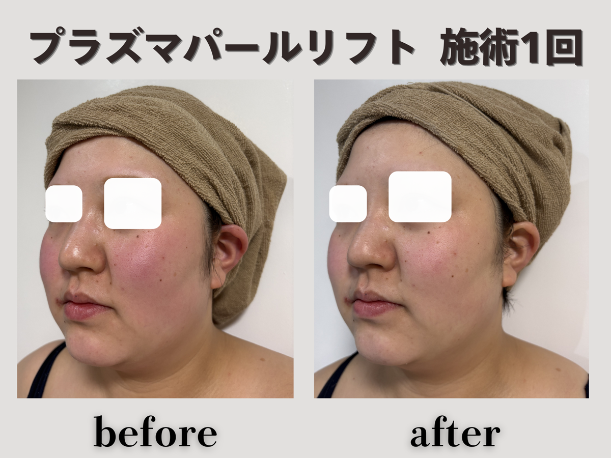 プラズマパールリフト 施術1回 斜め Before/After