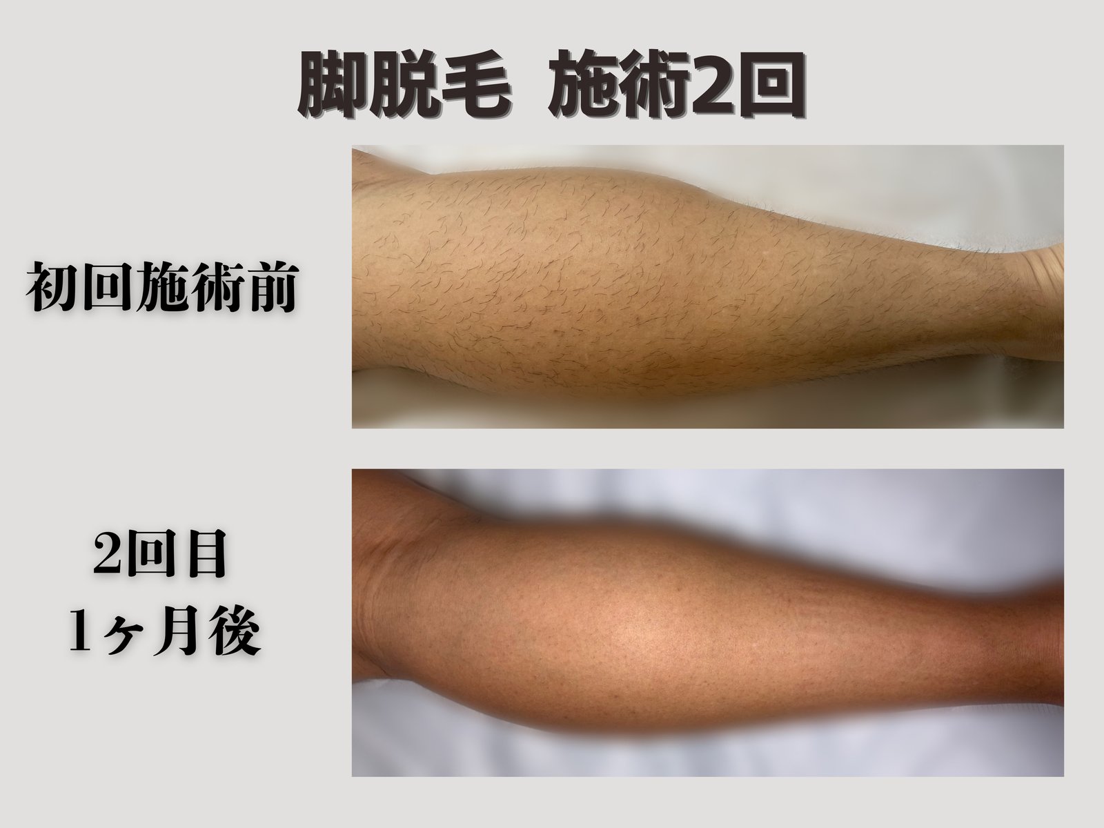 脚脱毛 施術2回 Before/After