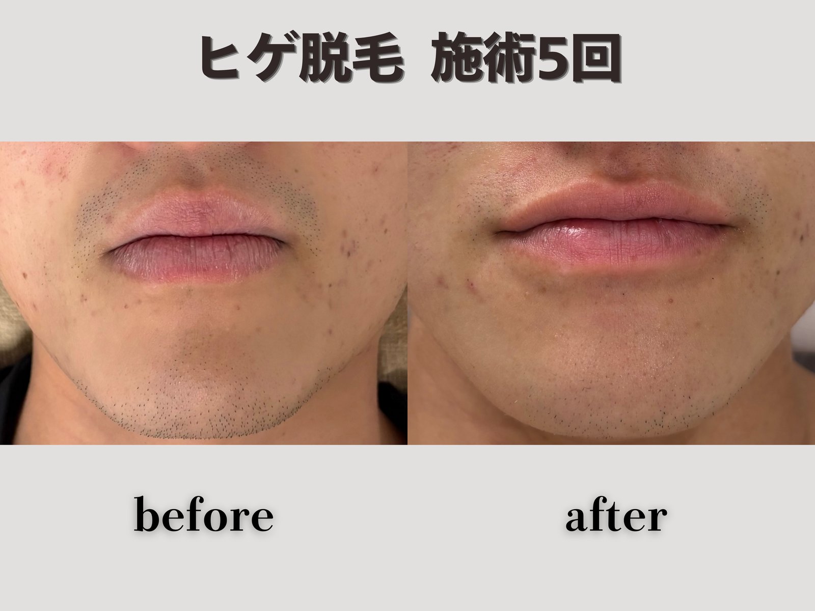 ヒゲ脱毛 施術5回 Before/After